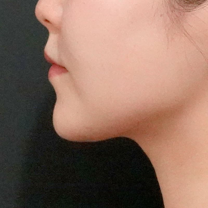 20260610_O37225_sato_face-liposuction_masseter-muscle-botox②After