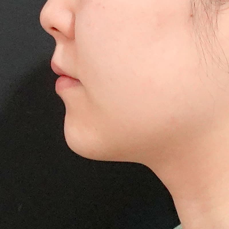 20260610_O37225_sato_face-liposuction_masseter-muscle-botox②Before