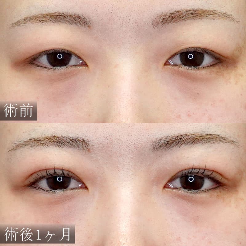 奥二重から自然な二重症例写真