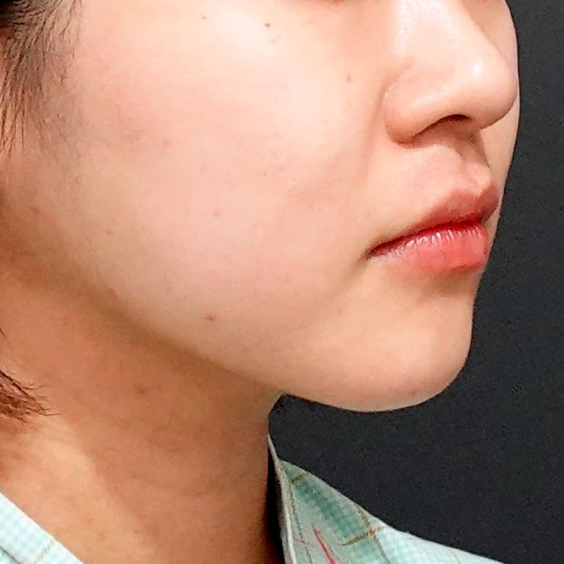 20260619_O33967_sato_face-liposuction_masseter-muscle-botox①After