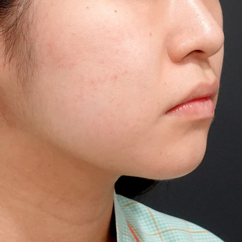 20260619_O33967_sato_face-liposuction_masseter-muscle-botox①Before