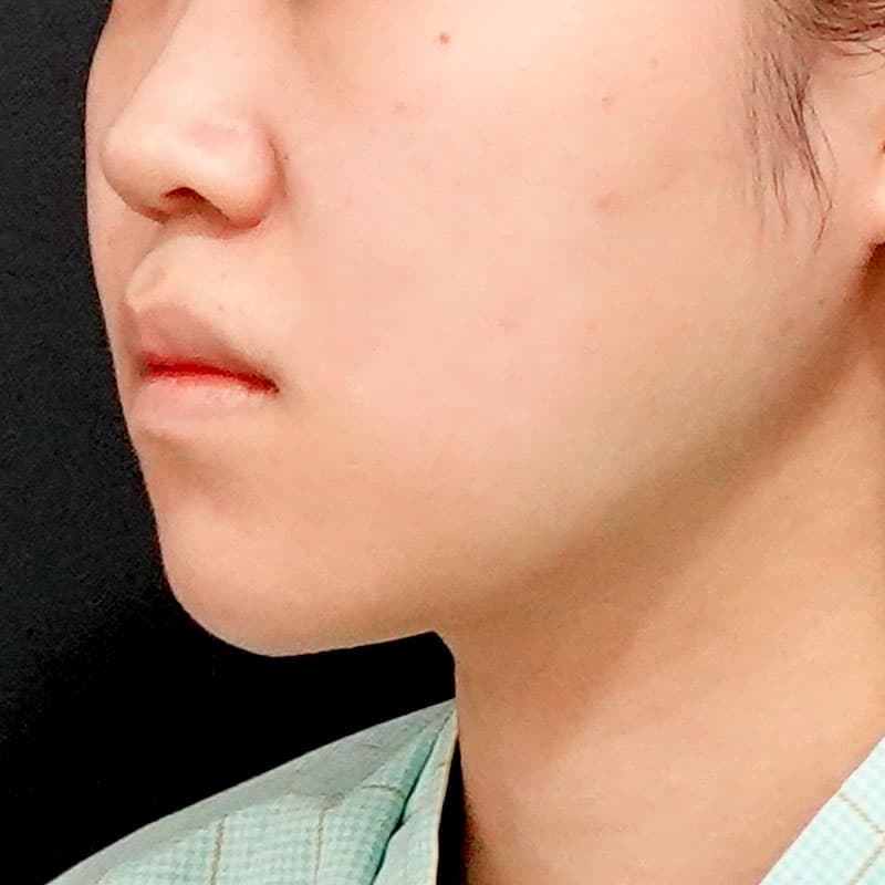 20260619_O33994_sato_face-liposuction_masseter-muscle-botox①After