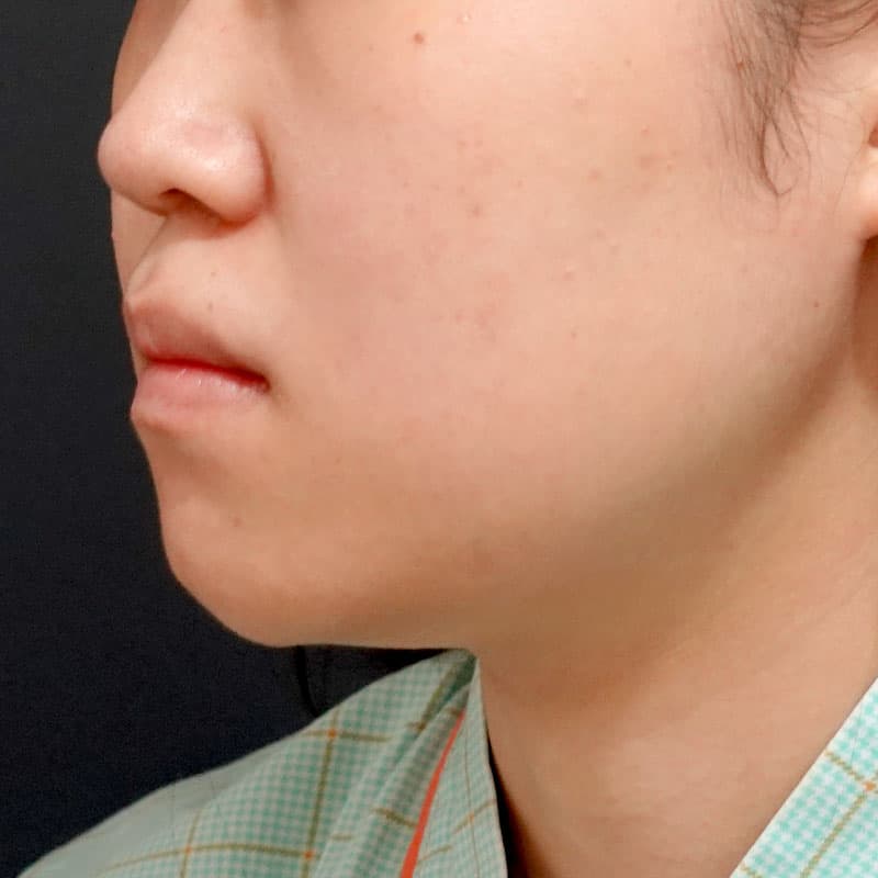 20260619_O33994_sato_face-liposuction_masseter-muscle-botox①Before
