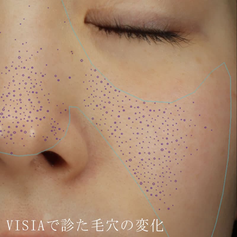 20260619_St20260619-1_retinol-peel②Before