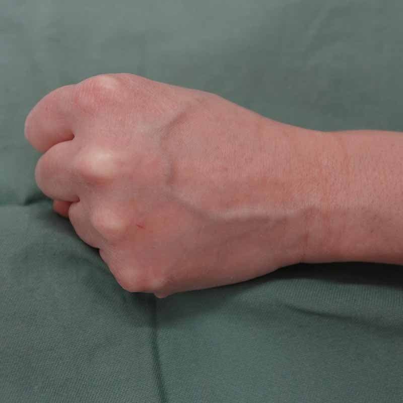 20260626_st0619_koito_hyaluronic back of the hand①Before
