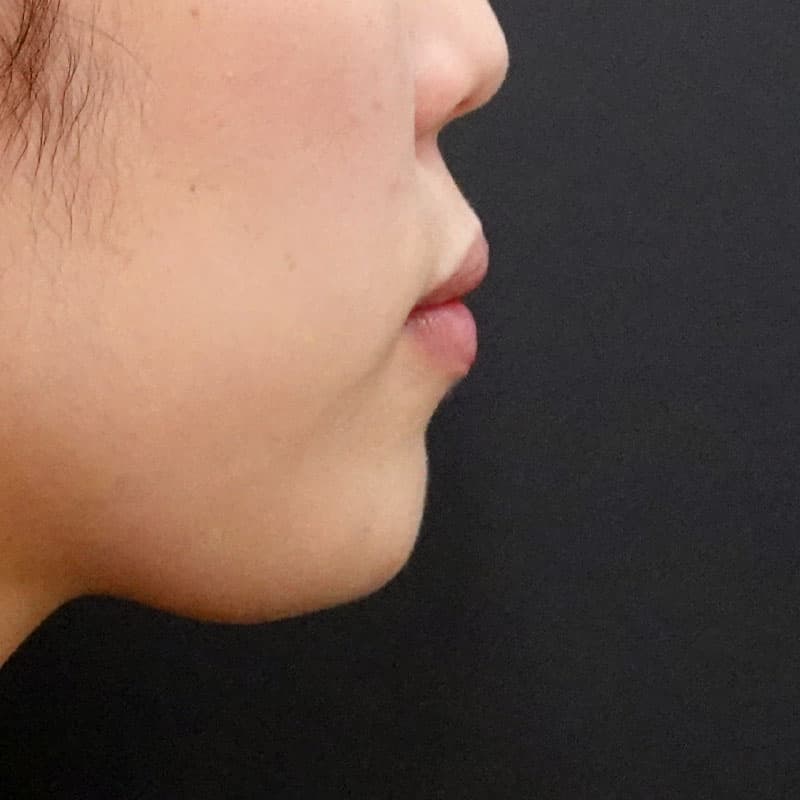20260628_F151605_nagahama_chin prosthesis①After