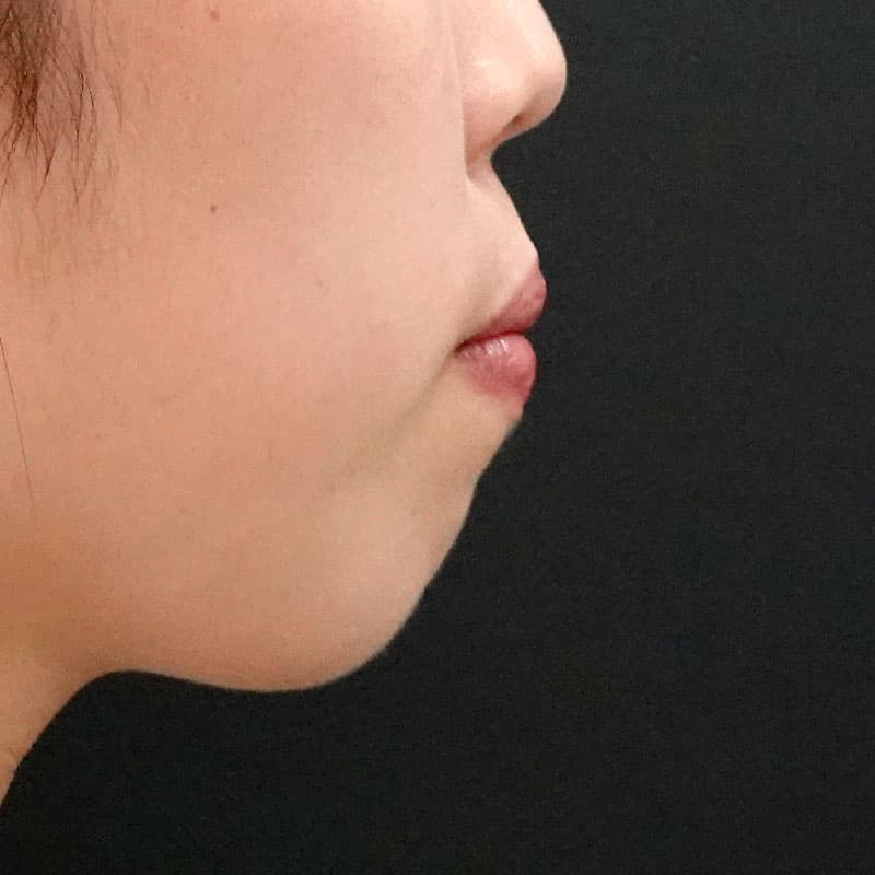 20260628_F151605_nagahama_chin prosthesis①Before