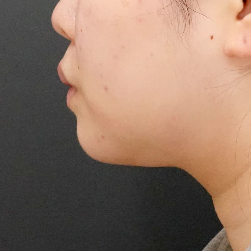 20260628_F153040_nagahama_face-liposuction_masseter-muscle-botox①After
