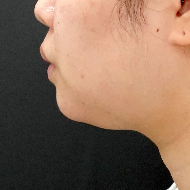20260628_F153040_nagahama_face-liposuction_masseter-muscle-botoxメイン横