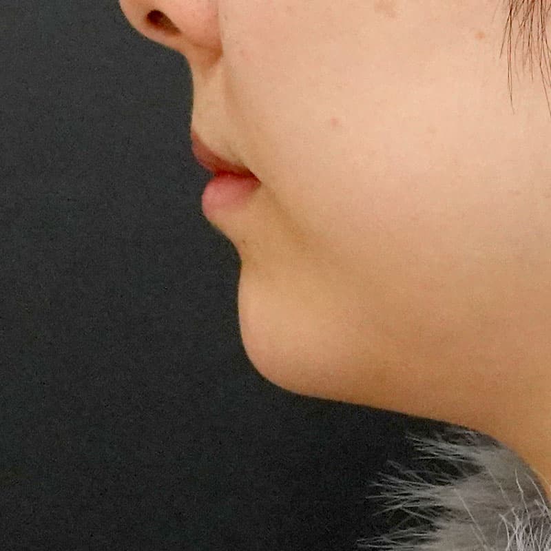 20260628_F777_nagahama_chin prosthesis①After