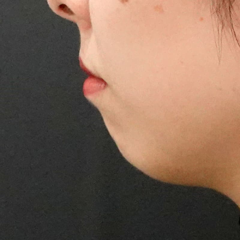 20260628_F777_nagahama_chin prosthesis①Before