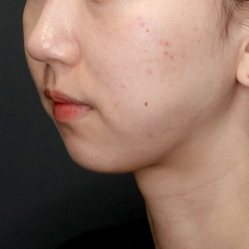 20260628_G25549_ishihara_face-liposuction_masseter-muscle-botox①After