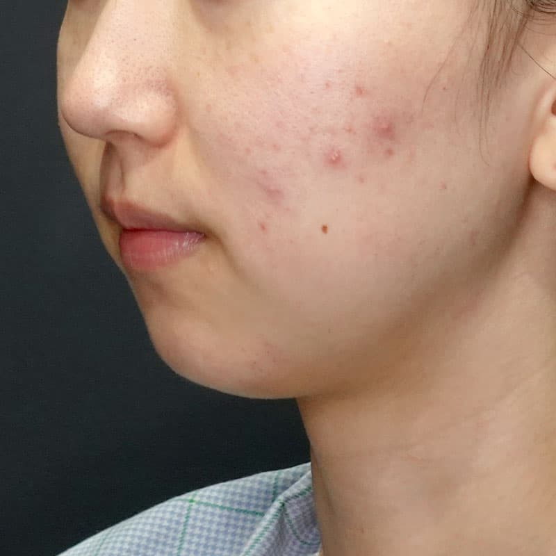 20260628_G25549_ishihara_face-liposuction_masseter-muscle-botox①Before