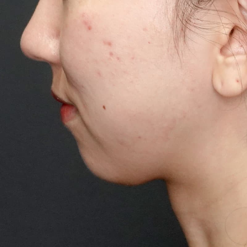 20260628_G25549_ishihara_face-liposuction_masseter-muscle-botox②After
