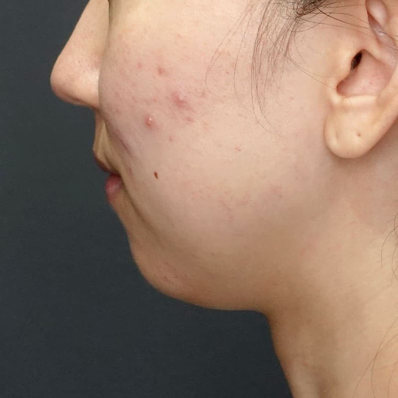 20260628_G25549_ishihara_face-liposuction_masseter-muscle-botox②Before