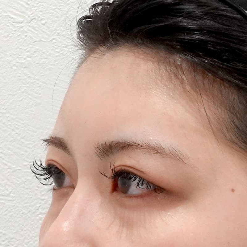 202606_N171783_takee_hyaluronic forehead- temples-nose-nasolabial folds-jaw①After