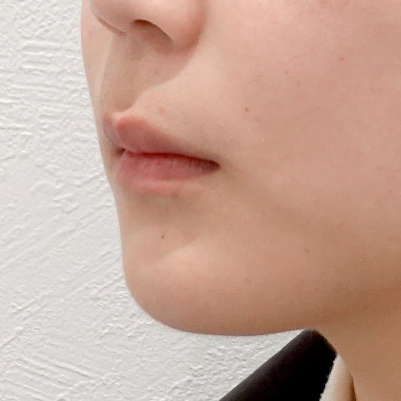 202606_N171783_takee_hyaluronic forehead- temples-nose-nasolabial folds-jaw②After