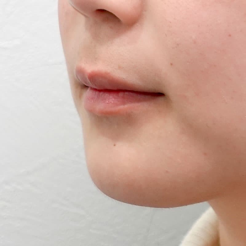 202606_N171783_takee_hyaluronic forehead- temples-nose-nasolabial folds-jaw②Before