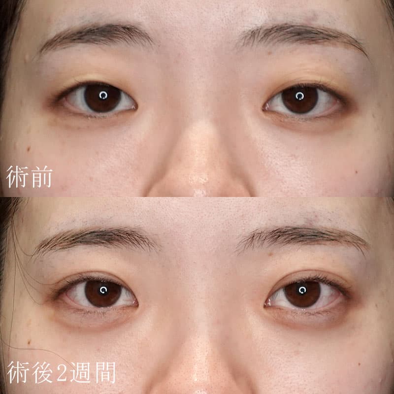 二重埋没法と涙袋ヒアルロン酸の症例写真【石原医師】