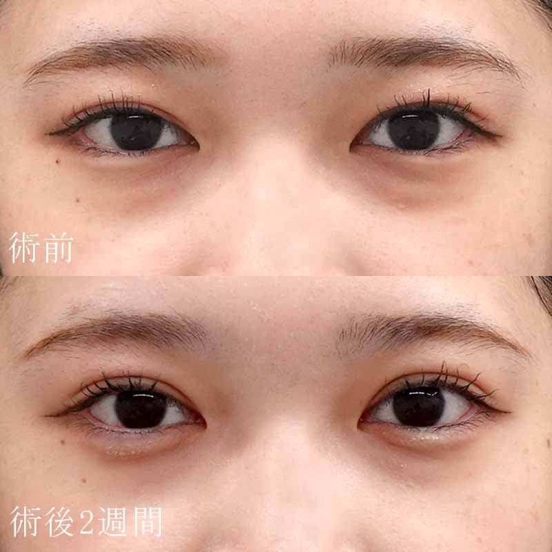 二重埋没法と涙袋ヒアルロン酸の症例写真【小野医師】