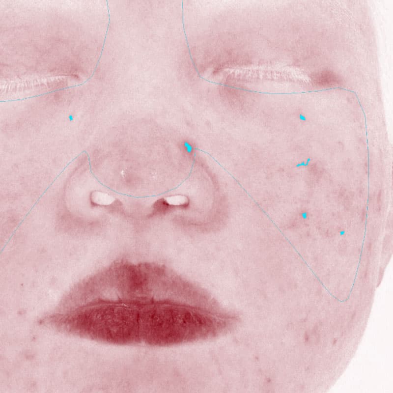 20260424_N48497_retinol-peel②After