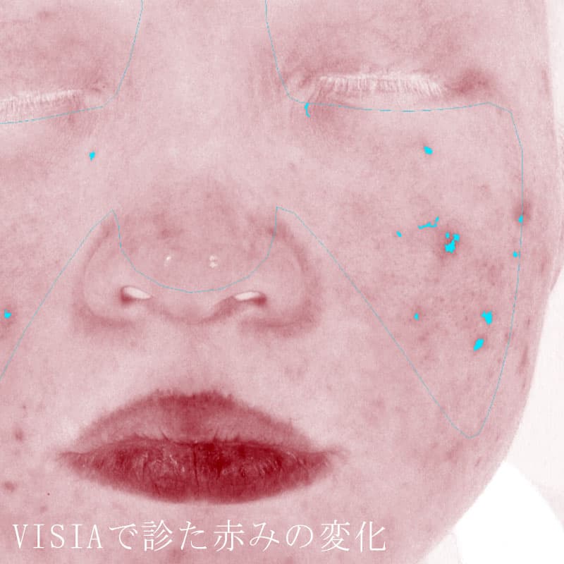 20260424_N48497_retinol-peel②Before