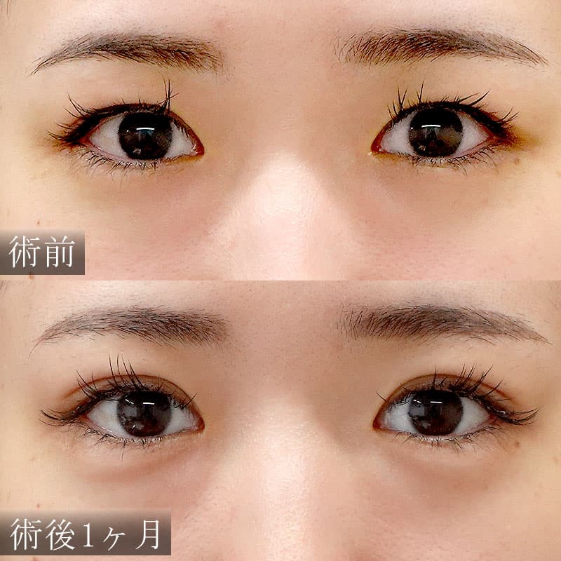 自然癒着法と涙袋ヒアルロン酸の症例写真【長田医師】