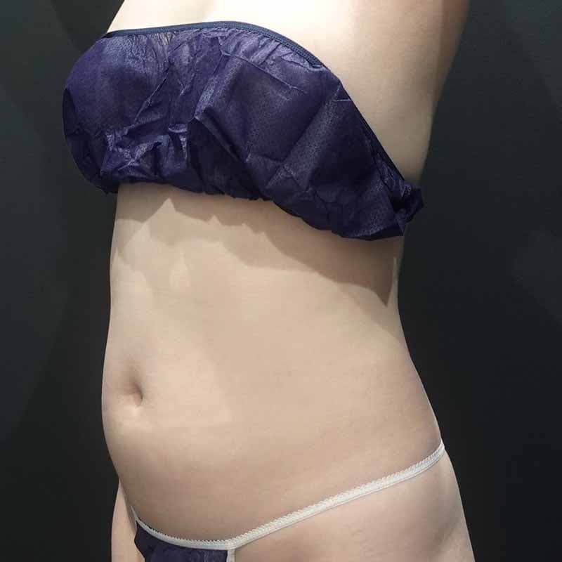 20260710_S127206_suzuki_stomach-liposuction①Before