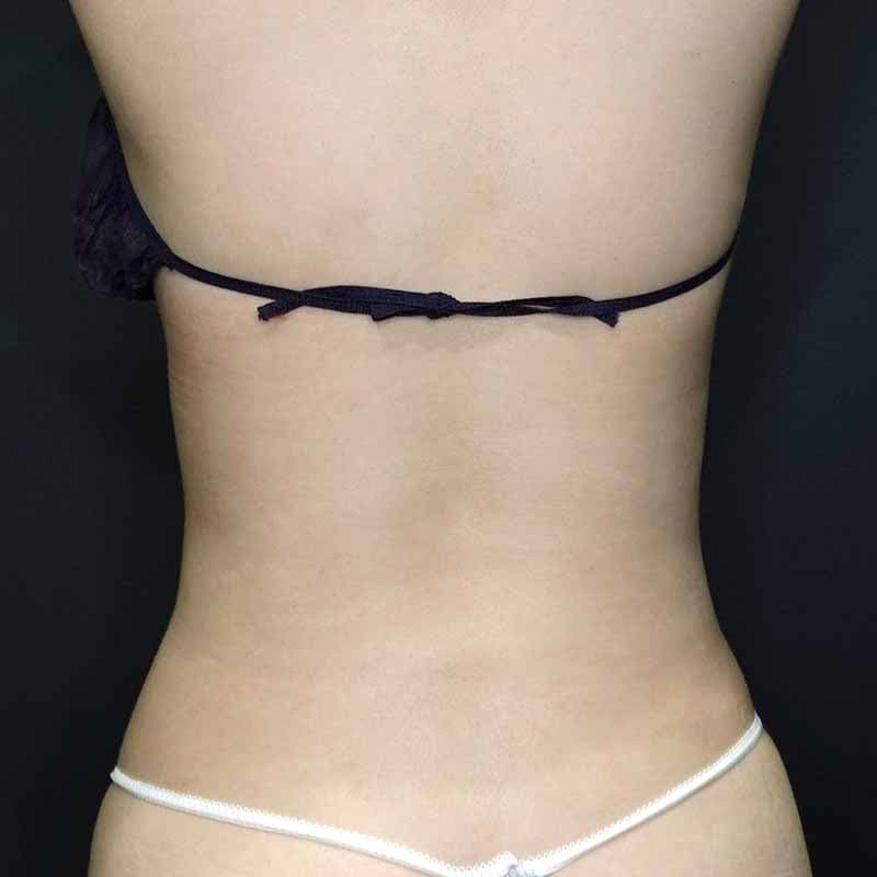 20260710_S127206_suzuki_stomach-liposuction②After