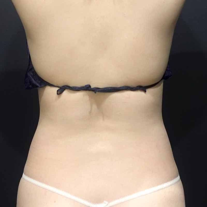20260710_S127206_suzuki_stomach-liposuction②Before