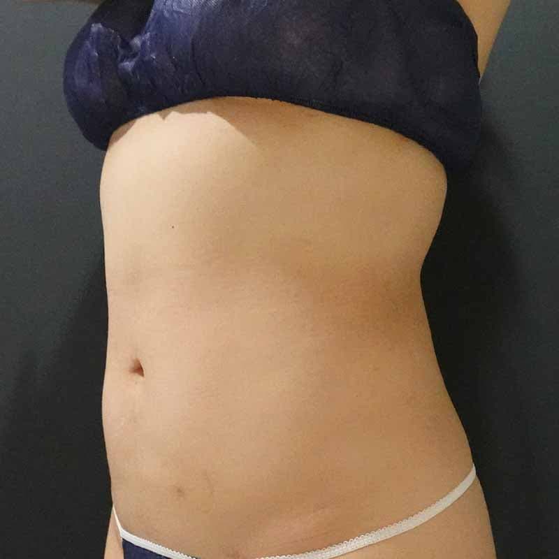20260720_Y128736_takemura_stomach-liposuction②After