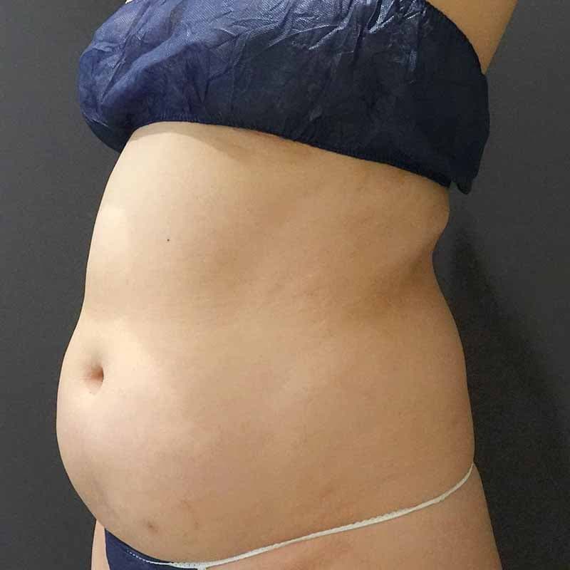 20260720_Y128736_takemura_stomach-liposuction②Before