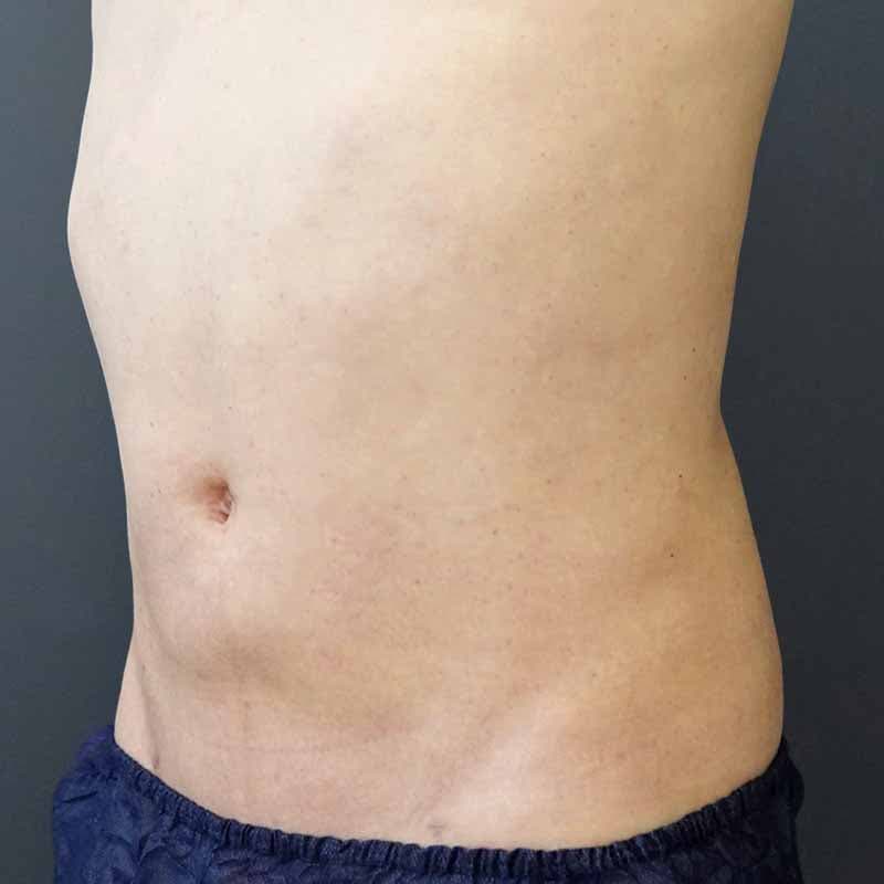 20260720_Y136827_takemura_stomach-liposuction①After