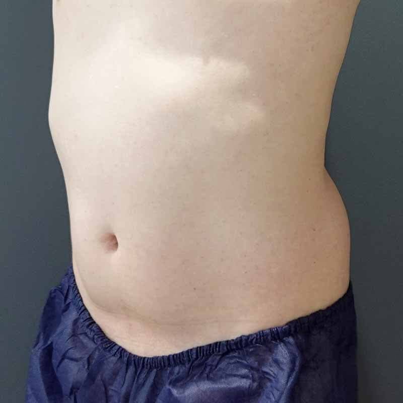 20260720_Y136827_takemura_stomach-liposuction①Before