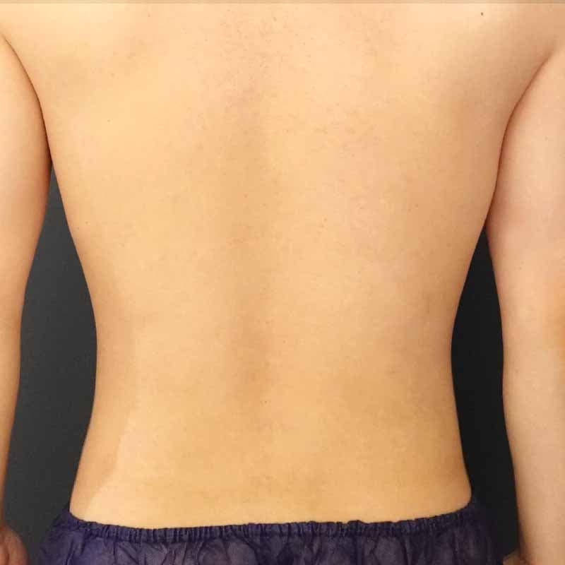 20260720_Y143878_takemura_stomach-liposuction①Before (1)