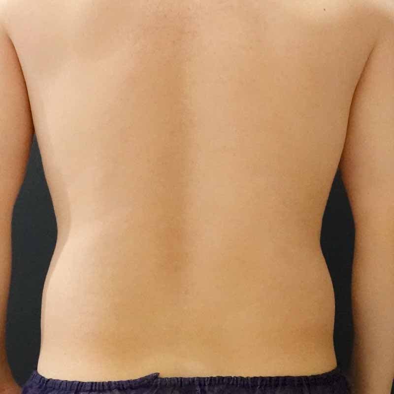20260720_Y143878_takemura_stomach-liposuction①Before (1)