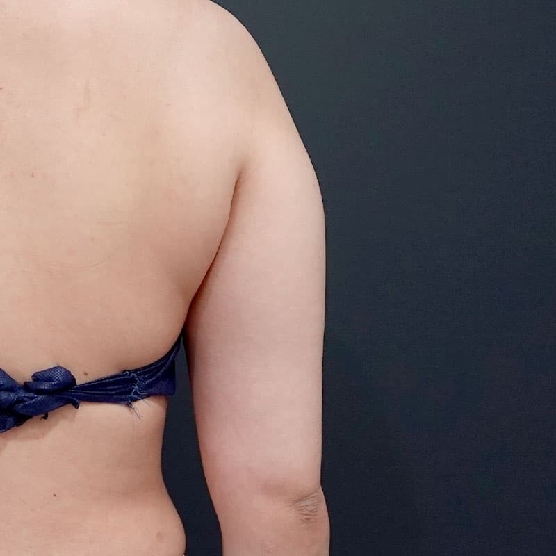20260723_St20260723_sugishima_arm-liposuction①Before