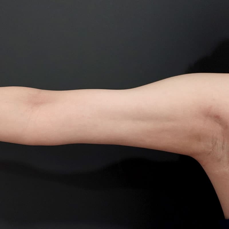 20260723_St20260723_sugishima_arm-liposuction②After