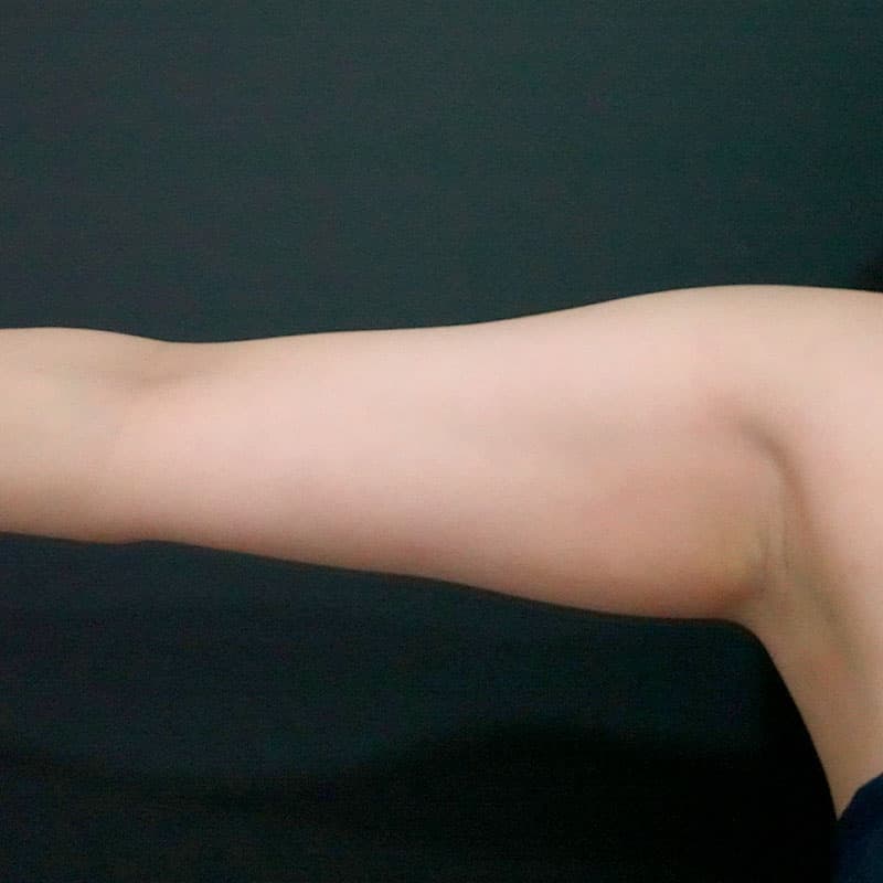 20260723_St20260723_sugishima_arm-liposuction②Before