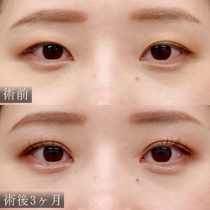 二重埋没法 症例(里 輝幸)
