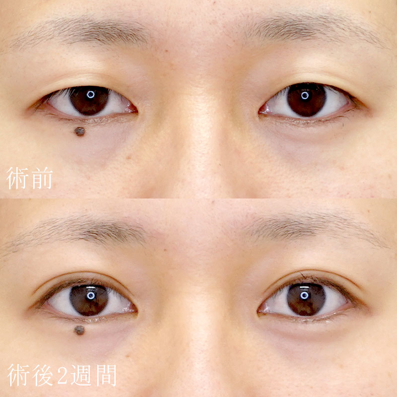 二重埋没法の症例写真【酒井医師】