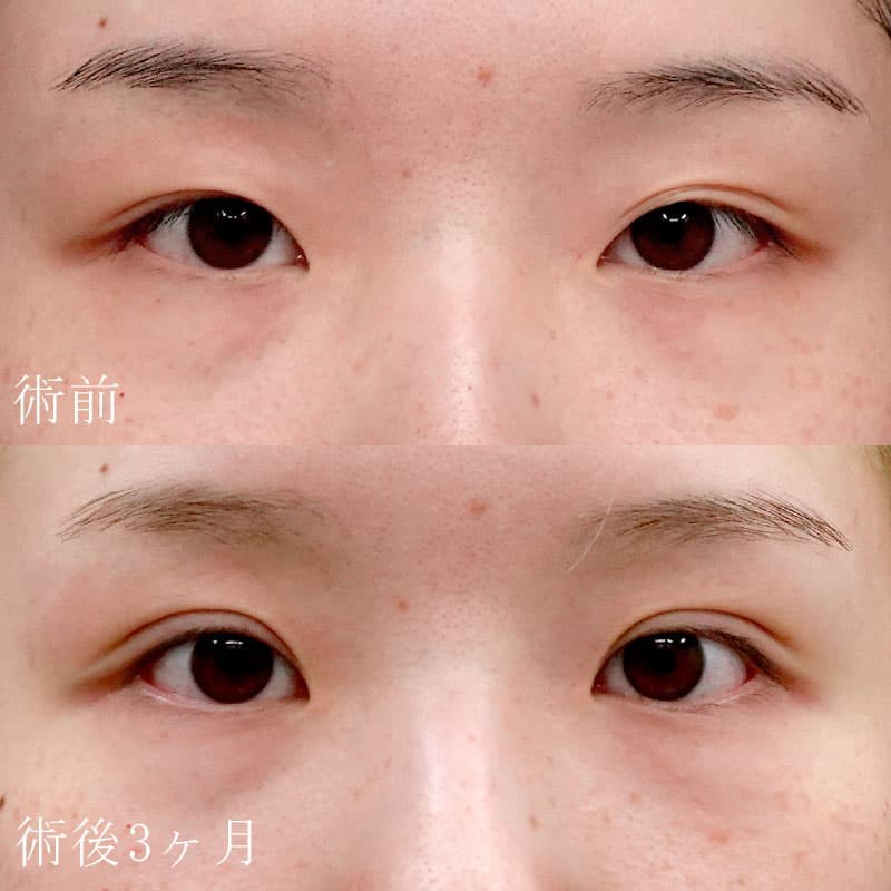 二重切開法の症例写真【杉島医師】