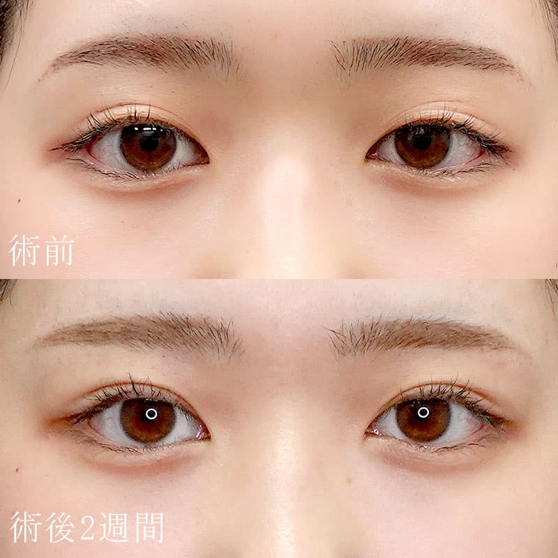 二重埋没法の症例写真【酒井医師】
