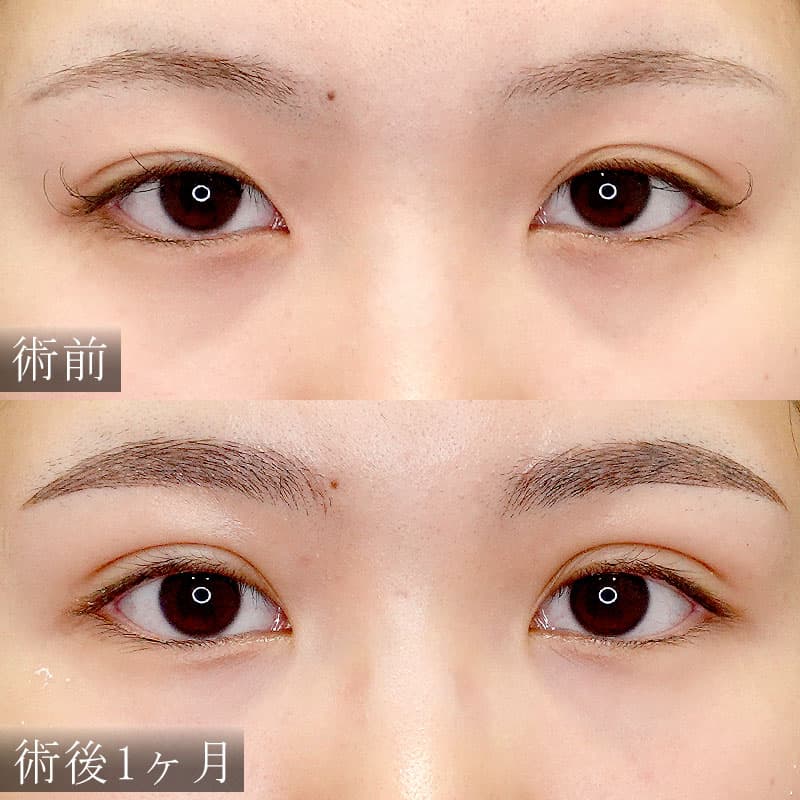 自然癒着法の症例写真【酒井医師】