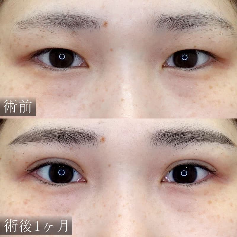 自然癒着法の症例写真【酒井医師】