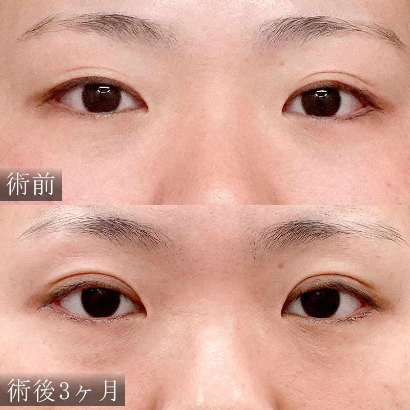二重切開法の症例写真【杉島医師】