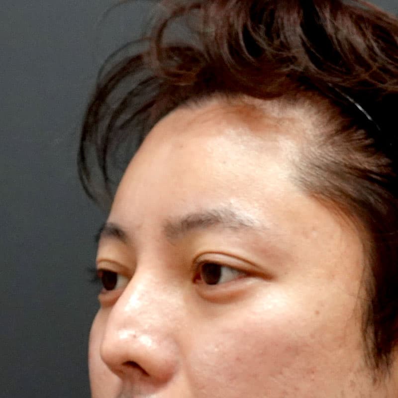 20260804_G128079_hosono_hyaluronic forehead- temples-temples①After