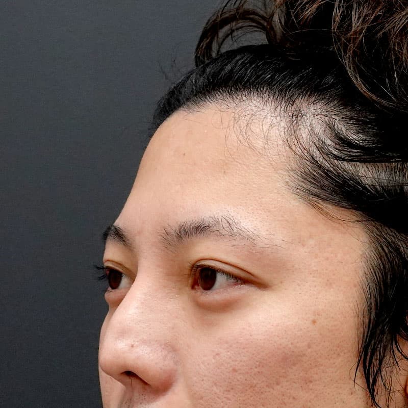20260804_G128079_hosono_hyaluronic forehead- temples-temples①Before
