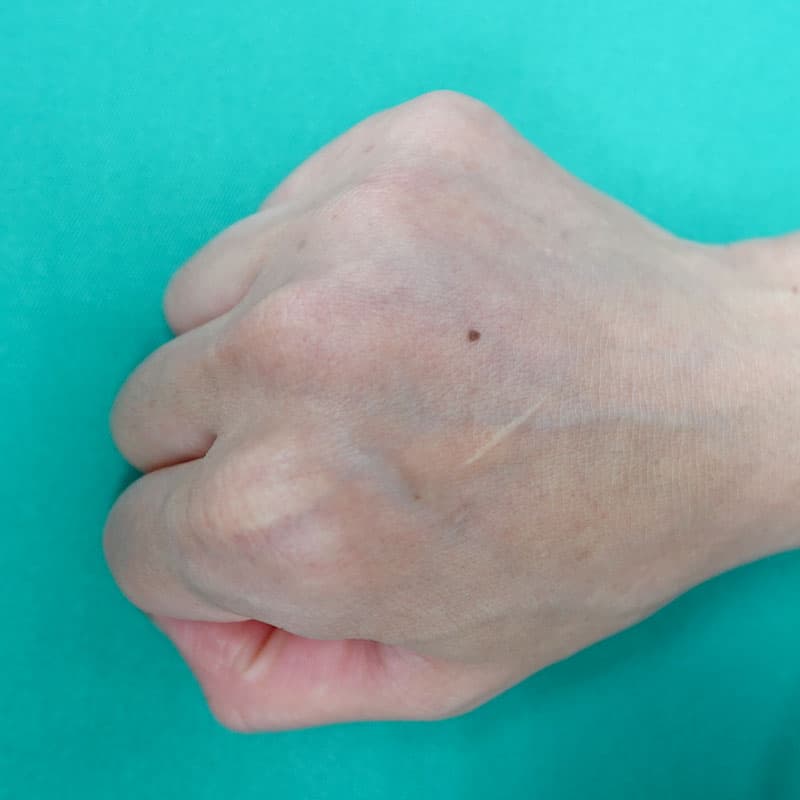 20260804_H153809_hosono_hyaluronic back of the hand①After