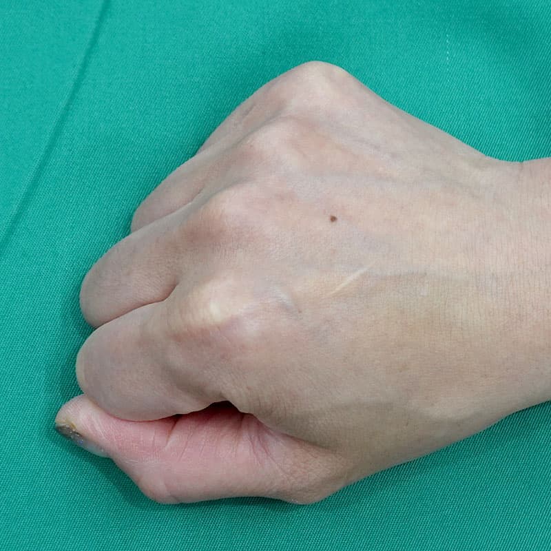 20260804_H153809_hosono_hyaluronic back of the hand①Before